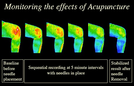 knee-acupunctuer-thermography